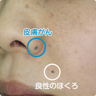 皮膚外科 | 泉ヶ丘皮フ科クリニック | 火傷(やけど) 皮膚腫瘍